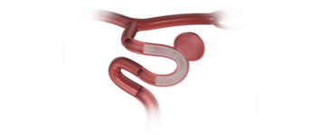 Stroke Treatment